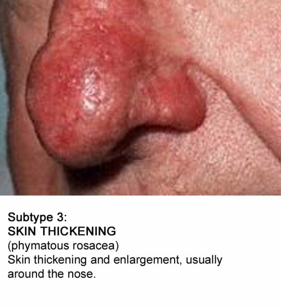Rosacea Subtype 3 Skin thickening.