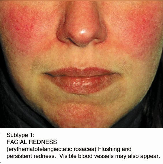 Rosacea Subtype 1: Facial Redness.
