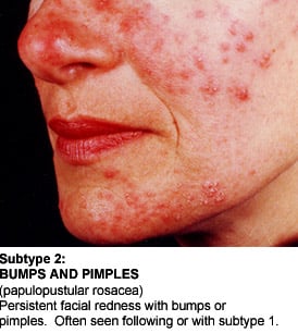 Rosacea Subtype 2: Bumps and Pimples